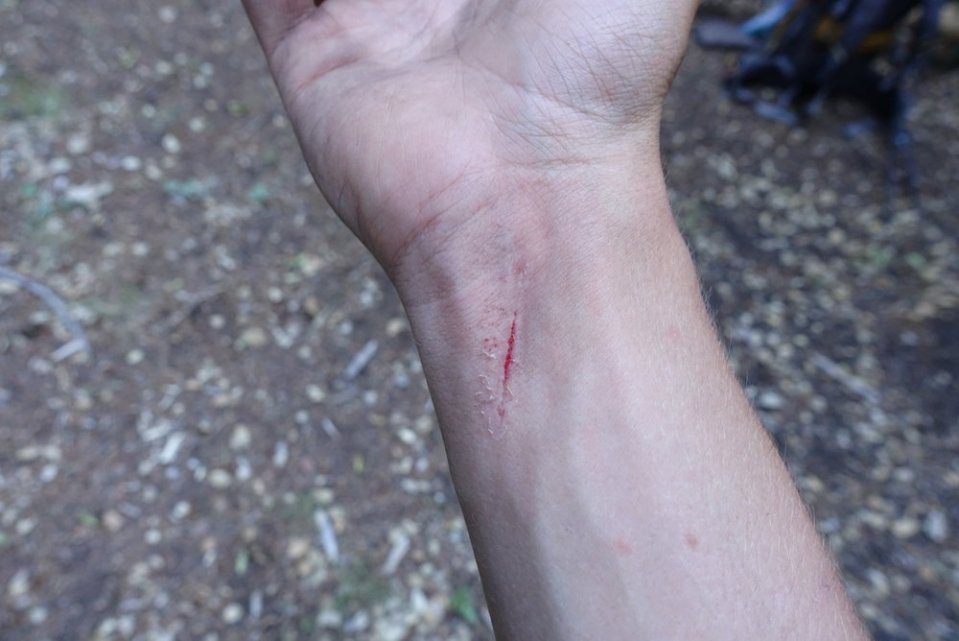  Battle scar of the day. 